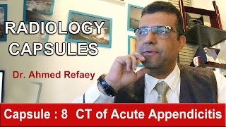 Capsule  8  CT of Acute Appendicitis [upl. by Assyram822]