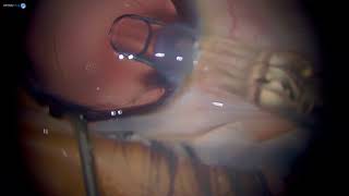 Surgery Pediatric Lamellar Cataract Dr Ramesh Kekunnaya [upl. by Addam21]