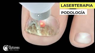 El laser terapéutico ZAFIRO para la onicomicosis en Podología [upl. by Aecila]