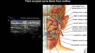 Ultrasound guided thrid occipital nerve block [upl. by Randolf]