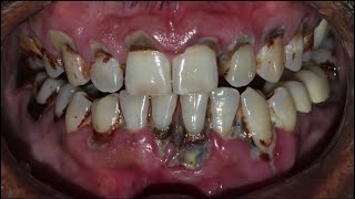 Scaling Treatment  Teeth scaling and Root Planing procedure DeepCleaning [upl. by Sorac]