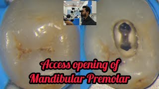 Access opening of Mandibular Premolar step by step demonstration Rct for beginners dental lectures [upl. by Gabie64]