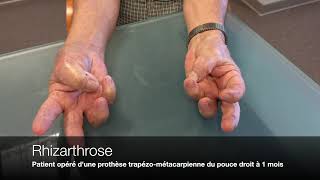 Main  Rhizarthrose ou Arthrose du pouce [upl. by Iz]