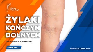 Żylaki kończyn dolnych  metody leczenia [upl. by Letnohs107]