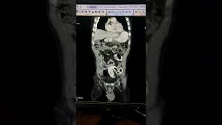 GASTROENTEROLOGY  Identify the spot diagnosis in given CECT ABDOMEN clip [upl. by Airdnas888]