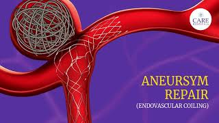 Aneurysm Repair  Endovascular Coiling  CARE Hospitals [upl. by Lilybelle126]