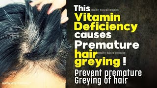 This Vitamin Deficiency causes premature hair greying  Prevent premature hair greying  Hair loss [upl. by Cressy]