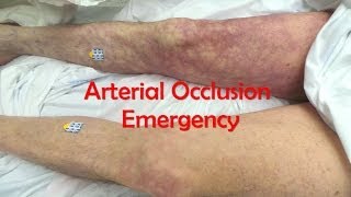 Acute Complete Occlusion of the Leg Arteries [upl. by Ardnaxela92]