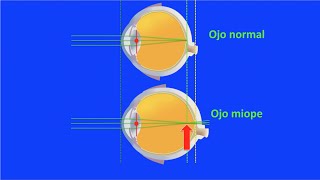 Optica ocular miopía hipermetropía y astigmatismo Centro de Oftalmología Bonafonte Barcelona [upl. by Nomis]