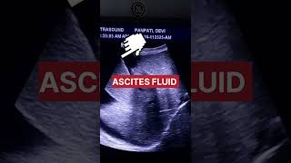 Ascites fluid radiology education best knowledgeablefact shorts [upl. by Auerbach]