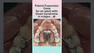 Palatal Expansion  MARPE Appliance👆🏻😳 orthodontictreatment specialneedsdentistry [upl. by Locklin]