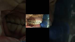 First and second mandibular molar implant bridge occlusal check for interference shorts [upl. by Pansie]