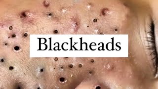 BIGGEST Blackheads Blackhead and MORE Blackheads Blackhead Removal [upl. by Rokach]