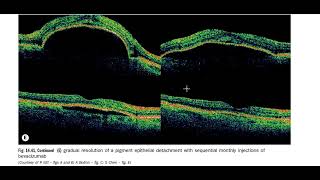 Kanski Clinical Ophthalmology Made Easy  Macula 5 B [upl. by Rehprotsirhc]