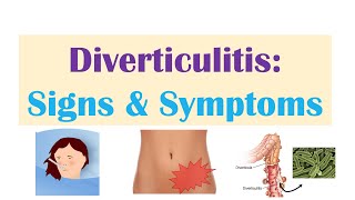 Diverticulitis Signs amp Symptoms And Why They Occur [upl. by Massiw343]