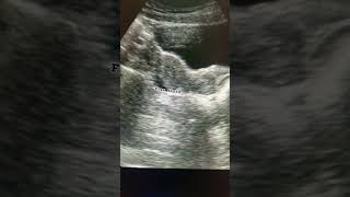 Pelvic ultrasound ultrasound pelvic pelvis medical study education shortfeed shortsviral yt [upl. by Rustice682]