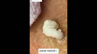 Blackheads Removal  Acne Treatment and Very Satisfying Satisfying Pimple pop blackheads [upl. by Seravat2]