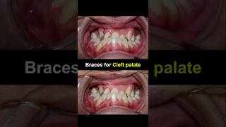 Braces for cleft palate braces orthodontist dentist dentisty [upl. by Nibbor14]