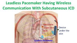 Leadless pacemaker having wireless communication with subcutaneous ICD [upl. by Nosyaj]