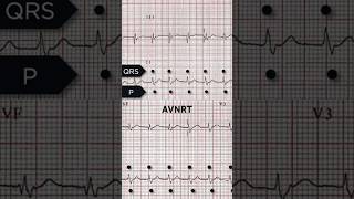 AVNRT ECG Retrograde p waves [upl. by Vanny713]