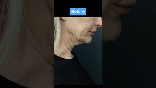 INSANE NECKLIFT TRANSFORMATION [upl. by Vincenty]