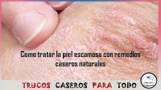 Como tratar la piel escamosa con remedios caseros naturales [upl. by Lahsiv33]