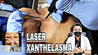 LASER CO2 XANTHELASMA DI NATASHA SKIN CARE  dr JEFFRY [upl. by Anyaj558]