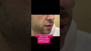 Acneiform Eruptions  Say no to steroid creams Dr Ashima Goel MD dermatologist [upl. by Sucramd]