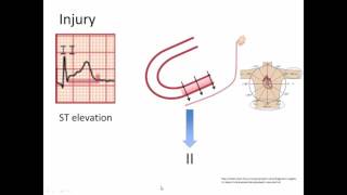 Ischemia Injury and Infarct [upl. by Aelaza]