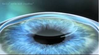 ReLEx SMILE Keyhole LASIK  animation [upl. by Tennies]