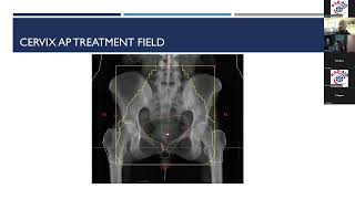 Radiation Therapy Treatment Planning Workshop  Pelvis Planning by RADAID International [upl. by Melvin]