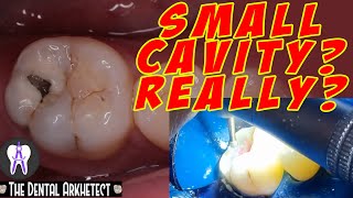 Molar Tooth Caries Removal and Restoration Pasta sa Bagang42 [upl. by Chemar]