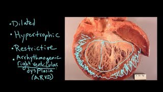 What is Cardiomyopathy [upl. by Otrebliw948]