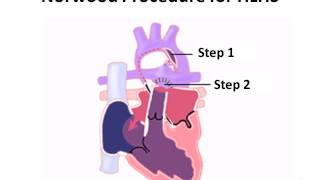 Norwood Procedure for Hypoplastic Left Heart Syndrome [upl. by Ahselyt]