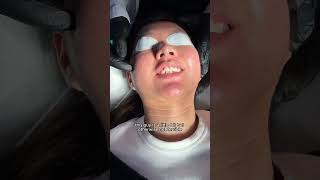 How To Treat Icepick amp Boxcar Acne Scars for Asian Skin TCA Cross CO2 amp Erbium Laser Explained [upl. by Rema]