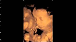 Echographie 3D 4D 22 sa Ultrasonography 3D fetus 22 Weeks [upl. by Asirehc909]