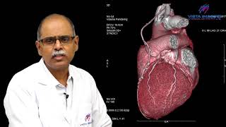 CT Coronary Angiogram  500 Slice CT [upl. by Pat]