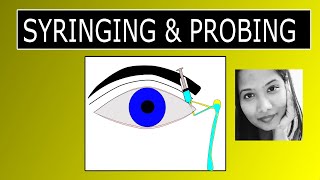 Lacrimal Syringing amp Probing  Procedure amp Interpretation of Results [upl. by Carolan670]