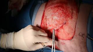 Large soft tissue sarcoma removal from the flank of a dog [upl. by Redna196]