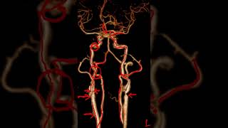 cerebral angiogram  session 4 [upl. by Ettesyl]