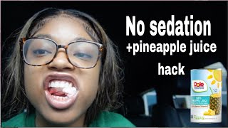 4 Wisdom teeth removed in 1 Day I Recovery Vlog Pineapple juice [upl. by Alecram]