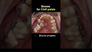 Braces for cleft palate progess braces orthodontist dentist dentistry [upl. by Gus381]