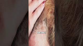 Simple Remedies to Relieve Scalp Psoriasis and Keep Your Scalp Healthy [upl. by Eltsryk]