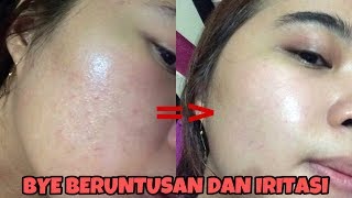 UPDATED SKINCARE UNTUK MENGATASI BERUNTUSAN DAN IRITASI [upl. by Sairtemed]