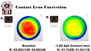 Anisometropia and Aniseikonia Treatment [upl. by Aikaj]