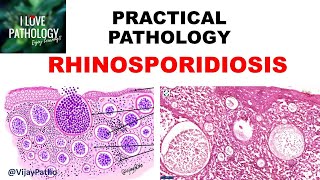 Practical Pathology RHINOSPORIDIOSIS [upl. by Eellehs]