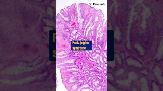 PeutzJeghers Syndrome  GI Polyps neetpg inicet fmge [upl. by Eiten673]