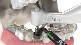 Dental Implantology  Guided Surgery Animation SICace implant insertion [upl. by Cowan146]