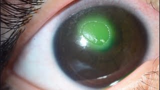 NEUROTROPHIC CORNEAL ULCER [upl. by Koal363]