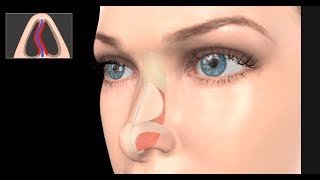 Deviated Septum Surgery Septoplasty [upl. by Notserp]